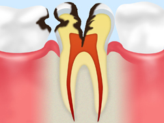 神経まで達した虫歯