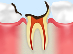 歯根まで達した虫歯