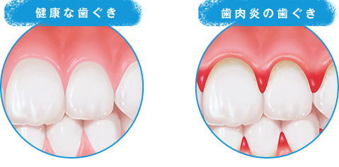 子どもでも歯周病（歯肉炎）になるってホント？